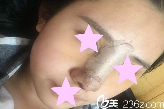 硅膠假體隆鼻手術第1天 硅膠假體隆鼻手術第1天