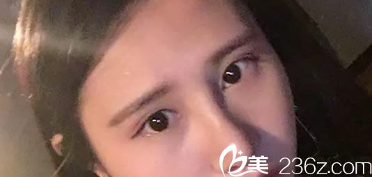 做完鼻綜合7天恢復效果 做完鼻綜合7天恢復效果