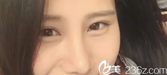 鼻綜合術后10天照片 鼻綜合術后10天照片