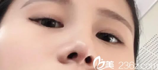 ?我在韓國(guó)娜娜整形金亨俊鼻綜合整形手術(shù)增加了我的顏值高度