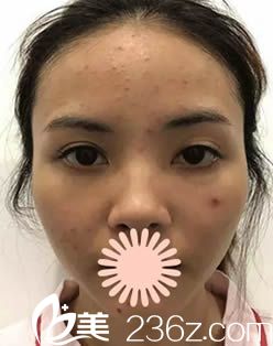 韓國清潭整形醫(yī)院術(shù)前隆鼻和面部填充術(shù)前照 韓國清潭整形醫(yī)院術(shù)前隆鼻和面部填充術(shù)前照