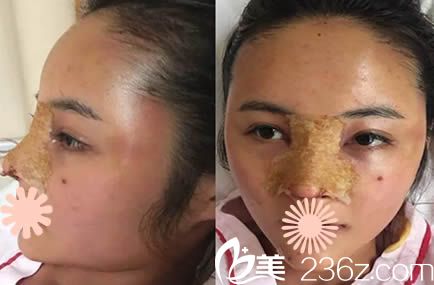 韓國清潭鼻綜合整形和面部脂肪填充手術(shù)第3天照 韓國清潭鼻綜合整形和面部脂肪填充手術(shù)第3天照