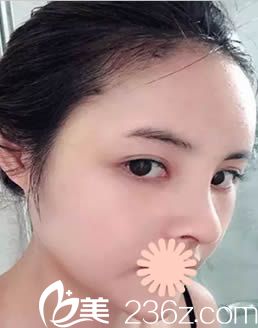 在韓國清潭整形醫(yī)院術(shù)后14天照 在韓國清潭整形醫(yī)院術(shù)后14天照