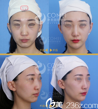 剛注射寶尼達玻尿酸隆鼻豐下巴術后即刻