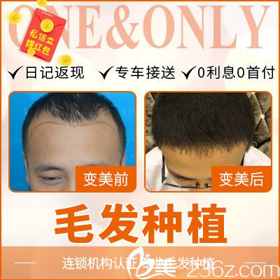 順德壹加壹瑪麗亞游鳳軍做的發(fā)際線種植<span style=