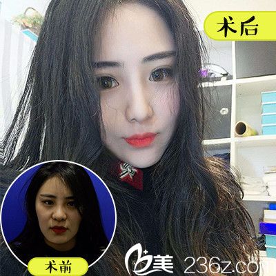 佛山順德壹加壹咼長模做的全臉自體脂肪面部填充<span style=