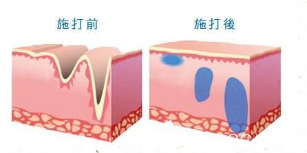 打玻尿酸前后對(duì)比