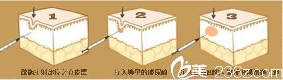 打玻尿酸會(huì)失明嗎？