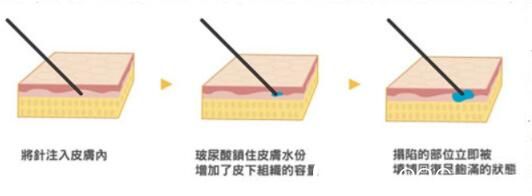 打玻尿酸失明后怎么辦？