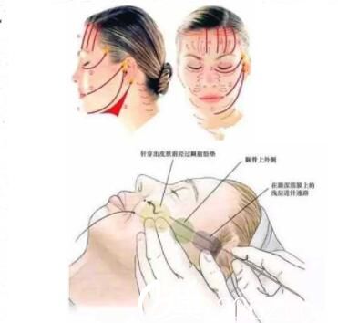 做完埋線提升術(shù)后如何保養(yǎng)