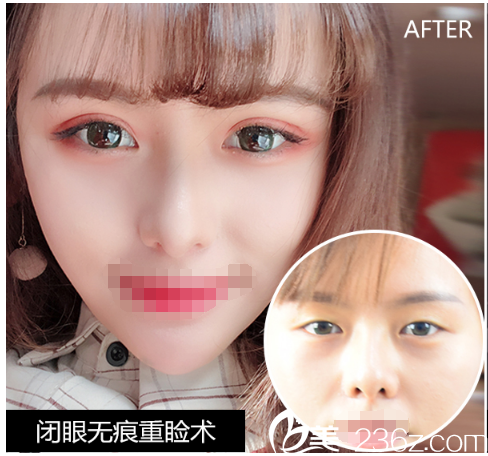 閉眼無痕重瞼術案例
