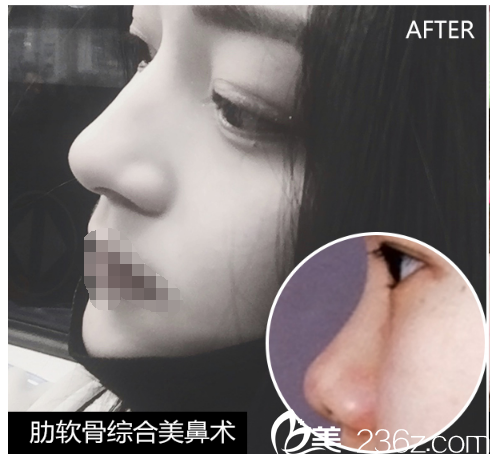 肋軟骨綜合美鼻術案例