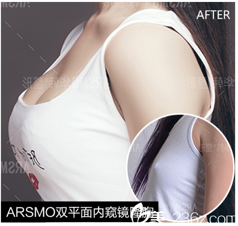 3D動感內窺鏡綜合隆胸術案例