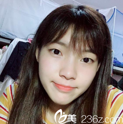 在佛山華美做雙眼皮手術(shù)前 在佛山華美做雙眼皮手術(shù)前