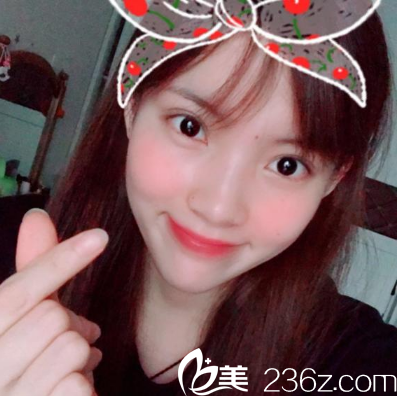 在佛山華美做完雙眼皮一個(gè)月自拍 在佛山華美做完雙眼皮一個(gè)月自拍