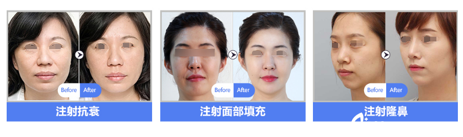 朱守超注射微整案例 朱守超注射微整案例