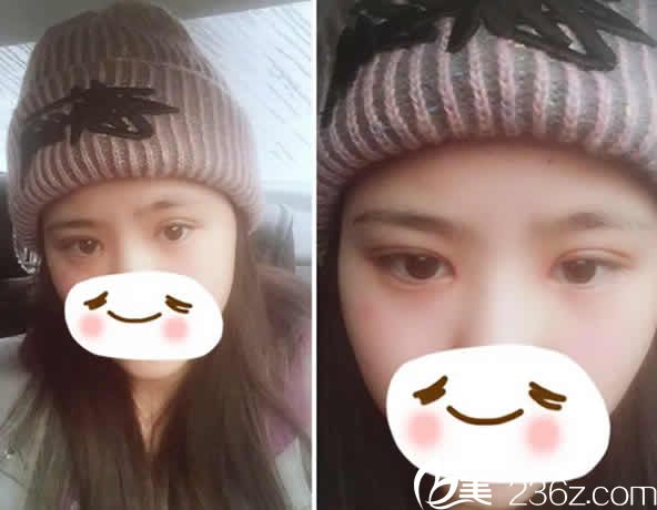 我在太原時光整形做切開雙眼皮和開眼角術(shù)后第12天照片 我在太原時光整形做切開雙眼皮和開眼角術(shù)后第12天照片