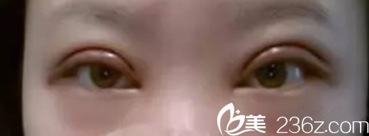 全切雙眼皮手術(shù)第1天