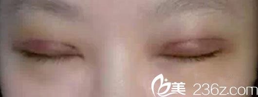 割雙眼皮7天后的恢復(fù)效果