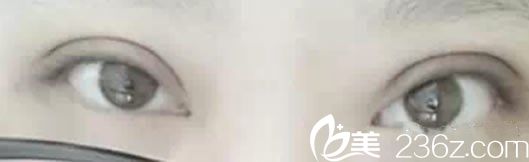 全切雙眼皮20天恢復(fù)圖