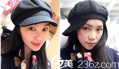 做完眼睛之后真的很腫