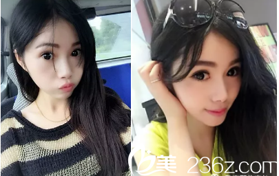 驚呆了！10月2號(hào)在整形醫(yī)院做的全切雙眼皮，花了我一萬(wàn)多