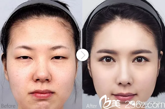 東莞華美任家驃做的雙眼破隆鼻<span style= 東莞華美任家驃做的雙眼破隆鼻<span style=