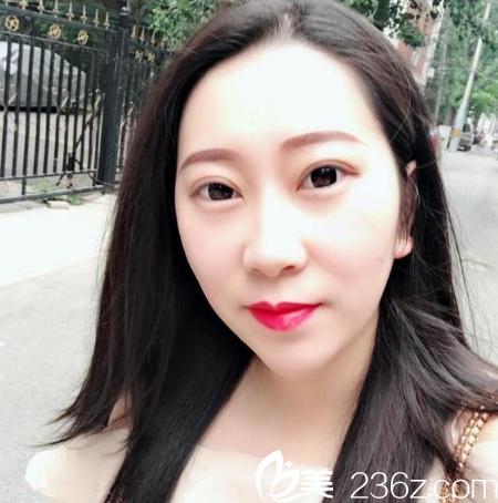 東莞西妃劉波院長做的雙眼皮效果 東莞西妃劉波院長做的雙眼皮效果