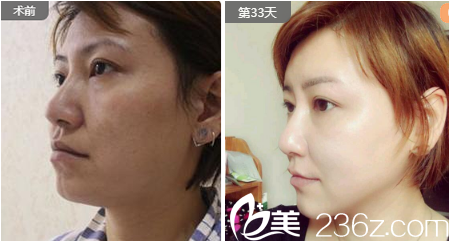 成都精美源周斌面部埋線提升案例