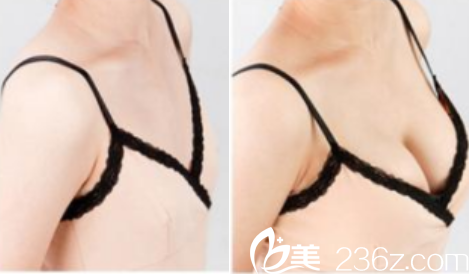 北京<!--<i data=20240703-sp></i>-->脂肪豐胸