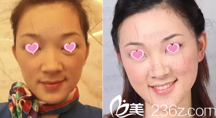 北京京韓面部脂肪填充