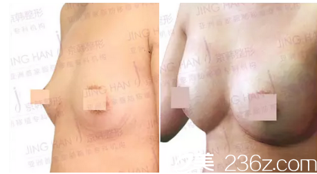 北京京韓脂肪豐胸