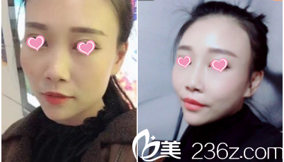 北京<!--<i data=20240703-sp></i>-->（<!--<i data=20240703-sp></i>-->）面部脂肪填充