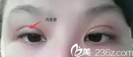 割雙眼皮手術(shù)后出現(xiàn)肉條