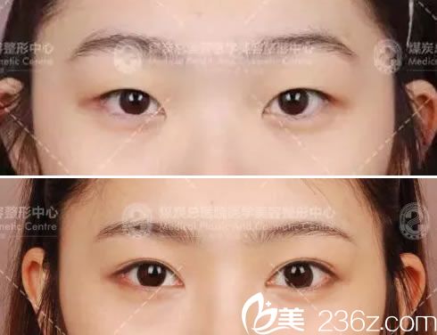 做雙眼皮成功案例效果
