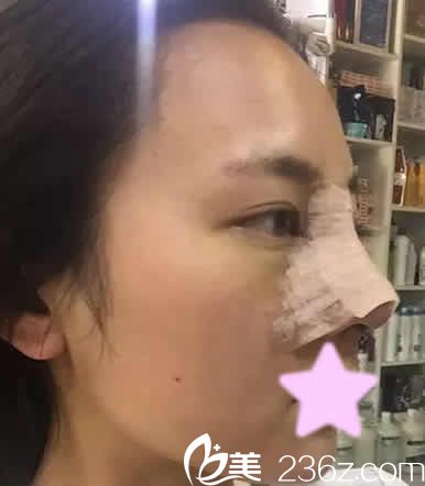聊城韓美倪景輝醫(yī)生給我做鼻綜合后第3天照片