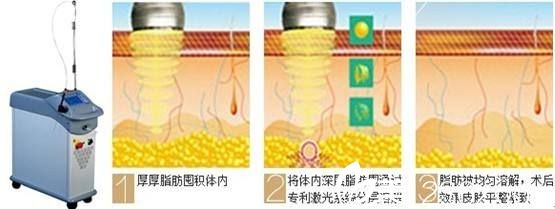 雅芳亞采用CGF自體脂肪移植技術