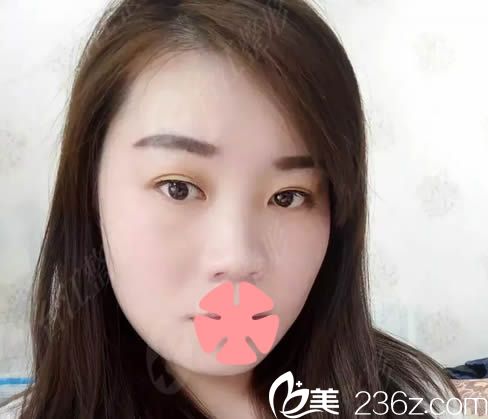 在福州臺江整形醫(yī)院隆鼻術前照 在福州臺江整形醫(yī)院隆鼻術前照