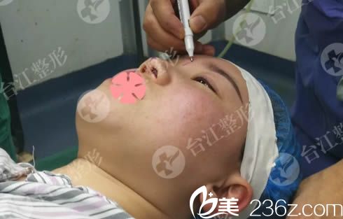 鼻整形前設計方案 鼻整形前設計方案