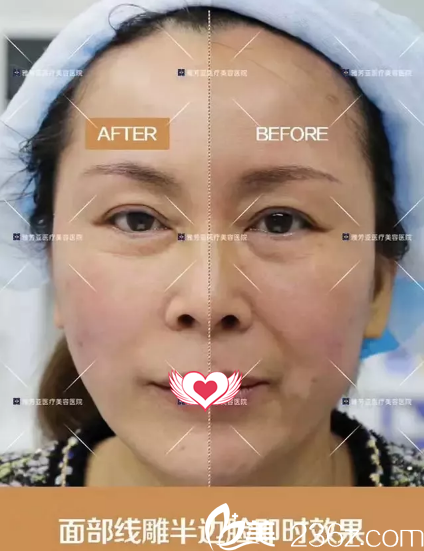 線雕術(shù)前后面部對比 線雕術(shù)前后面部對比