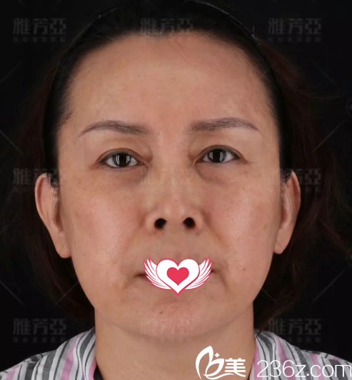 術(shù)前面部皮膚松弛下垂 術(shù)前面部皮膚松弛下垂