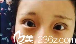 術(shù)后兩天效果 術(shù)后兩天效果