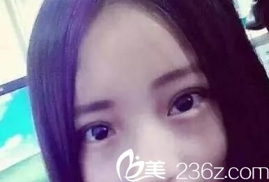 術(shù)后7天效果 術(shù)后7天效果