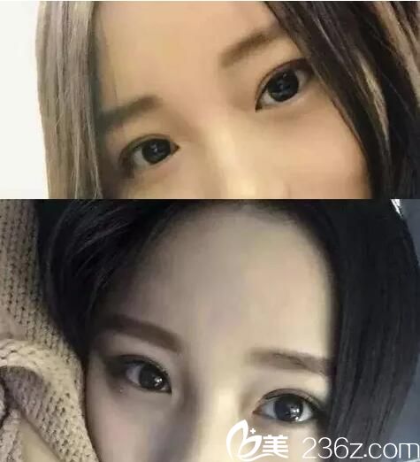 因長久使用雙眼皮貼造成眼瞼松弛 在宜昌前衛(wèi)做了個(gè)雙眼皮手術(shù)僅需15天就解決了 