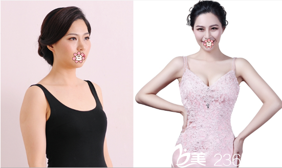 成都精美源整形周斌自體脂肪豐胸案例 成都精美源整形周斌自體脂肪豐胸案例