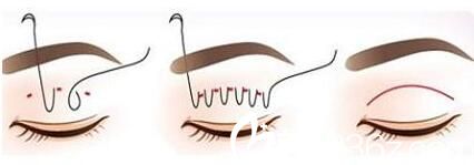 那些情況需要做雙眼皮修復(fù)