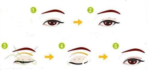 全切雙眼皮修復(fù)好不好？