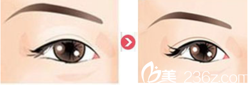 雙眼皮術(shù)前術(shù)后范例