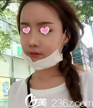 自體脂肪豐蘋果肌后13天