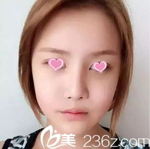 史希杰給我做自體脂肪全臉手術(shù)20天了